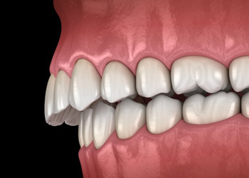a 3D example of an overbite
