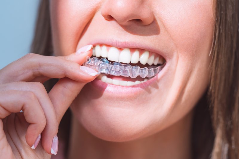 up-close view of person inserting clear aligner 